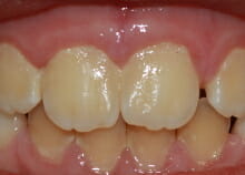 early orthodontics - teeth straightening for children in essex after early orthodontics - teeth straightening for children in essex after