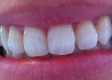 Cosmetic Teeth Whitening Cosmetic Teeth Whitening