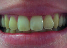 Cosmetic Teeth Whitening before Cosmetic Teeth Whitening before