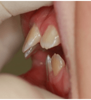 overbite-before photo fixing an overbite problem