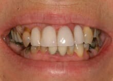 smile before before photo smile makeover