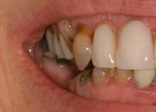 smile-side-before smile makeover photo side view before