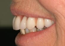 smile-sideshot-after smile makeover side photo after