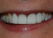 after-veneers instant veneers before and after