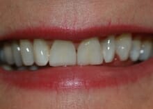 after-whitening instant veneers before and after photos