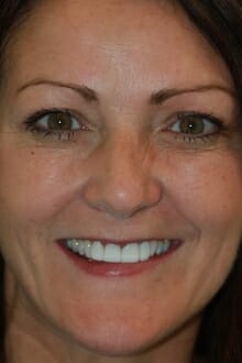 smile-after cosmetic smile before and after pictures