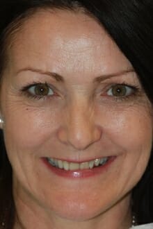 smile-before cosmetic smile before and after photos