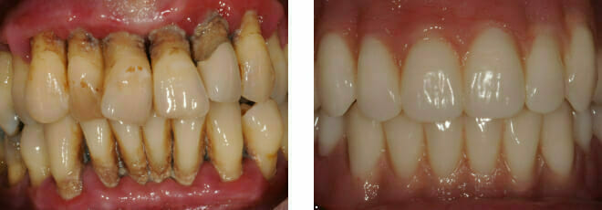 Failing Teeth from Periodontal Disease | Gum Disease Treatment in Romford, Essex | The Art of Dentistry Dental Clinic