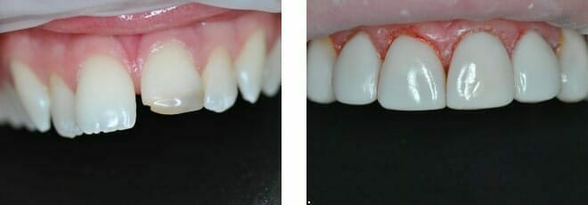 Diastema Closure in Romford, Essex | The Art of Dentistry Dental Clinic