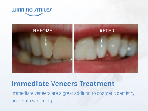 teeth veneers before and after