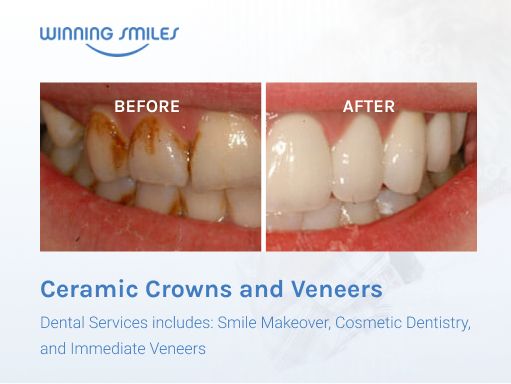 teeth veneers before and after