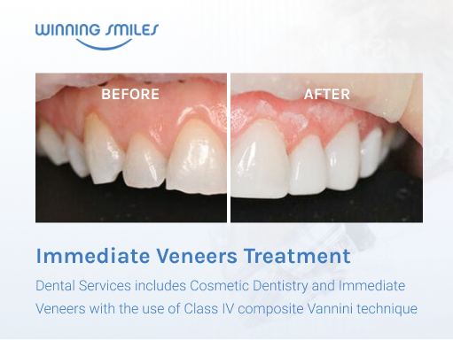 teeth veneers before and after