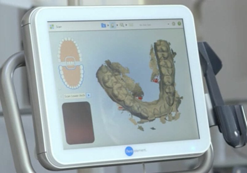 ws-orthodontics-itero-image-breaker ws-orthodontics-itero-image-breaker